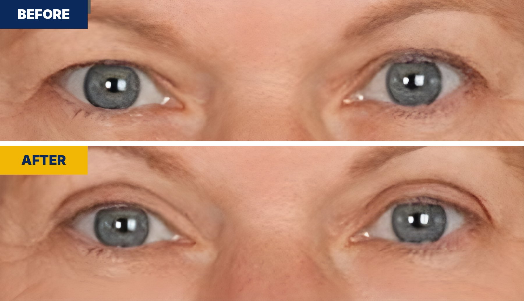 EasyLift® before and after, real result