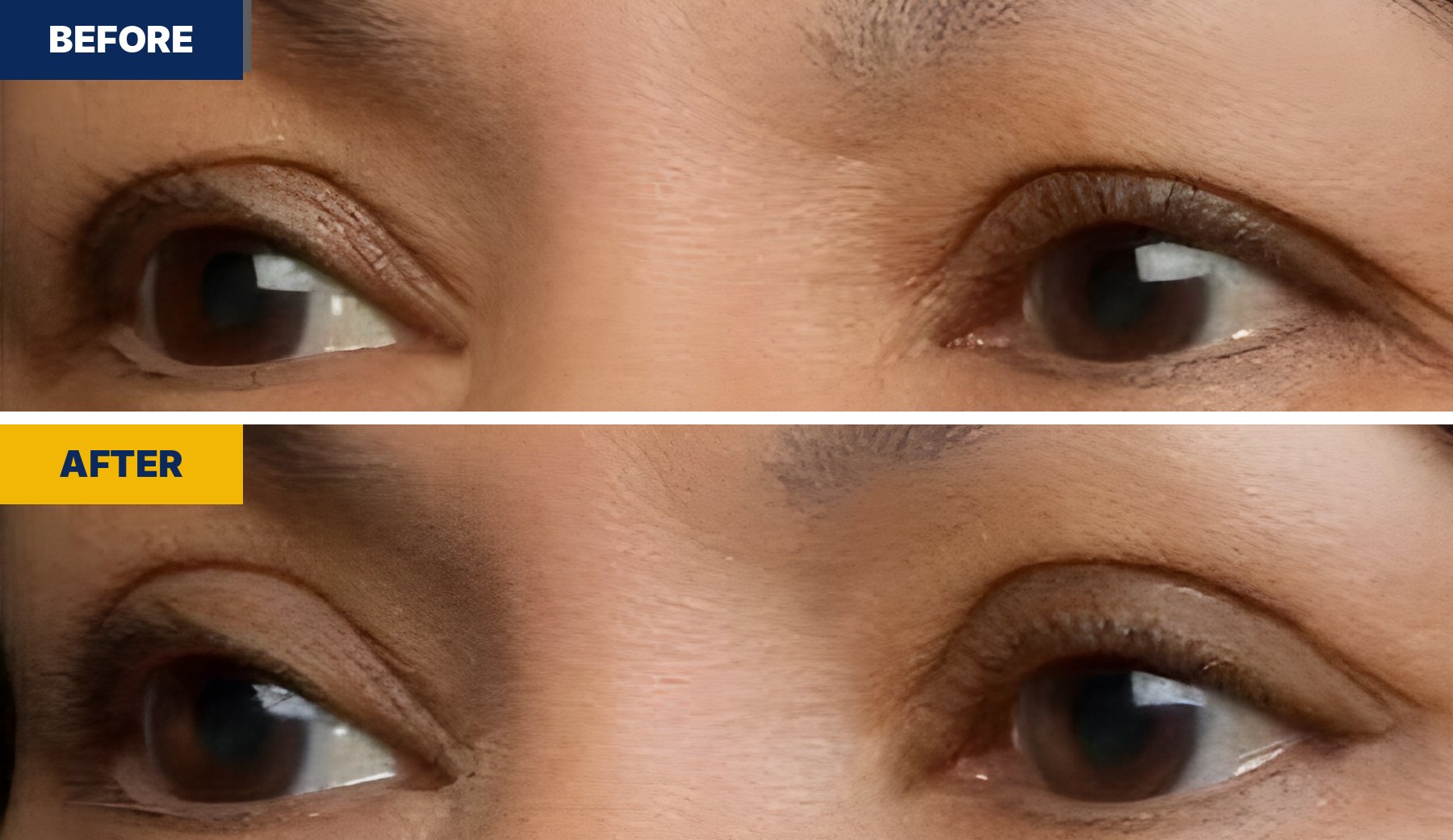 EasyLift® before and after, second real result