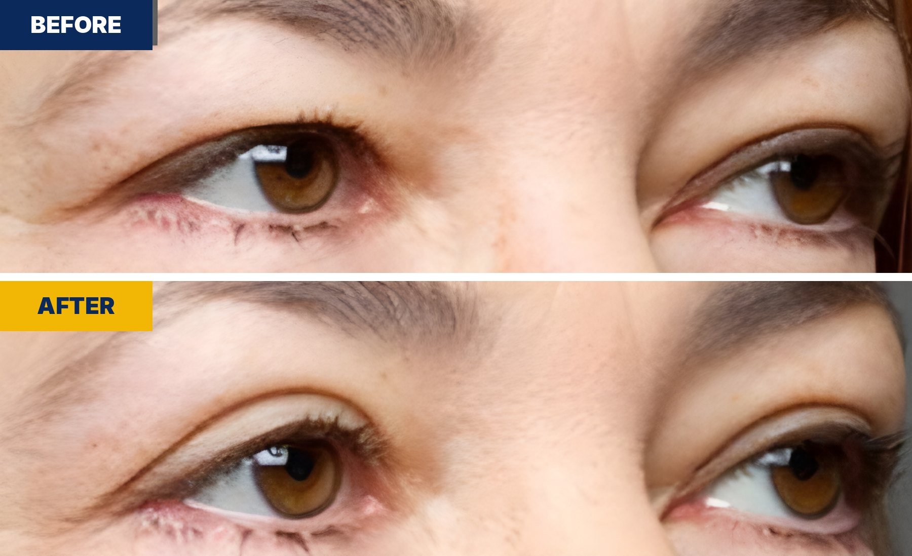EasyLift® before and after — upper eyelids lifted for a more open look